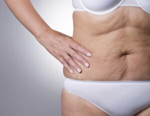 se debarasser de la cellulite