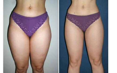 resultat-liposuccion-cuisses-Tunisie