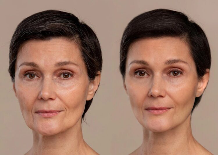 resultat-lifting-cervico-facial